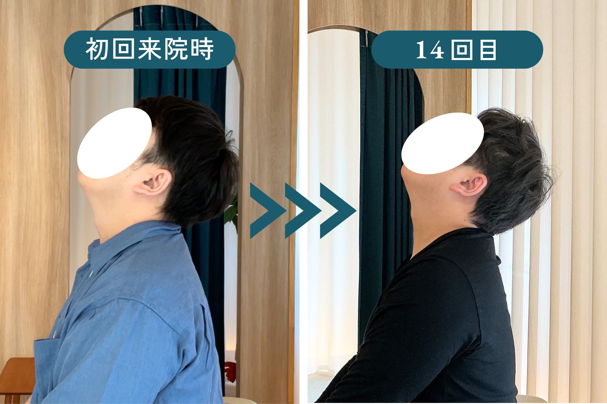 K様 初回来院時 → 14回目のビフォーアフター｜頭部姿勢の劇的変化