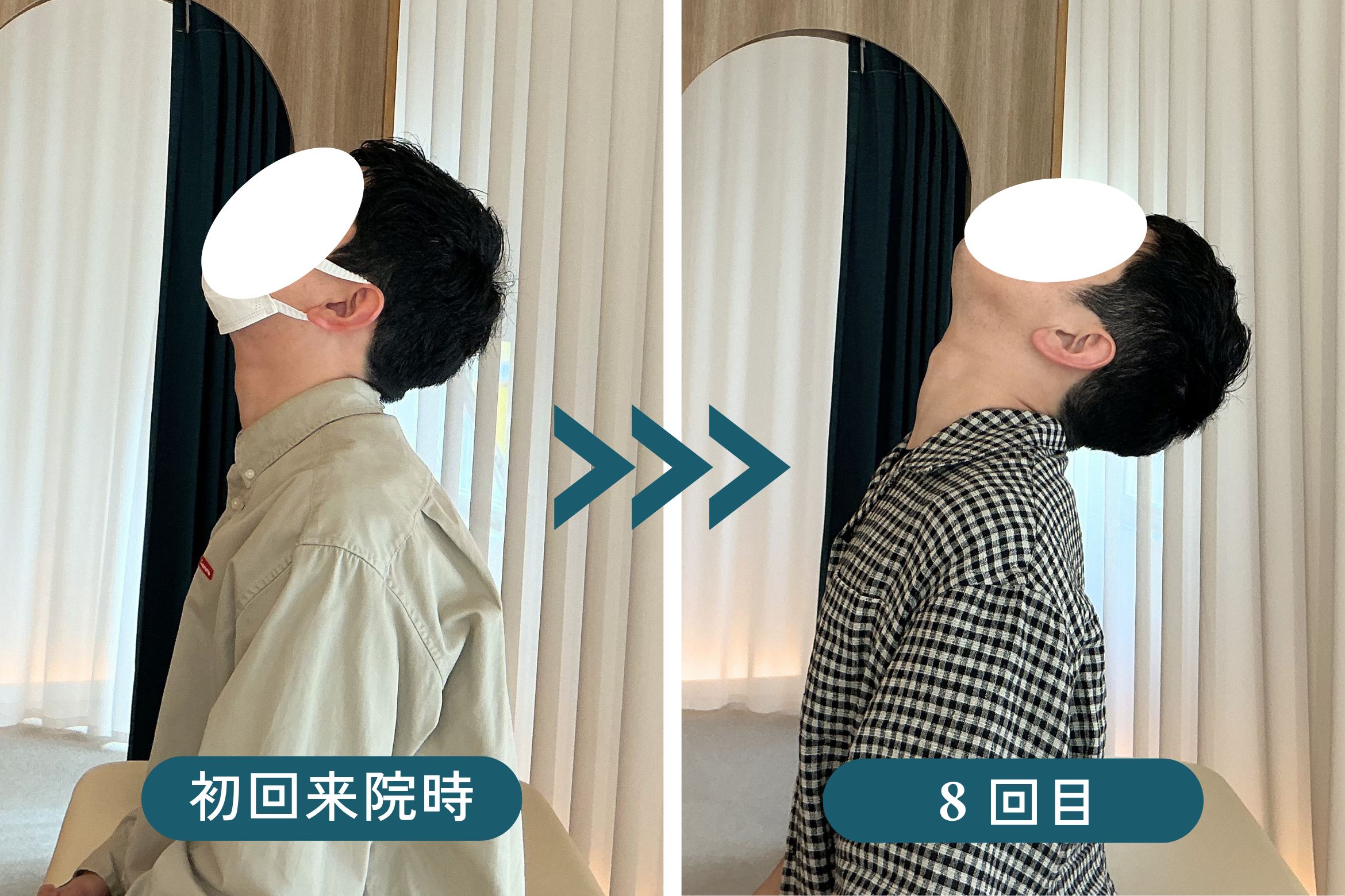 広島市中区大手町の慢性肩痛 頸部後屈動作Before/After(矢状面)｜リリーフポート整体院 大手町店 T様