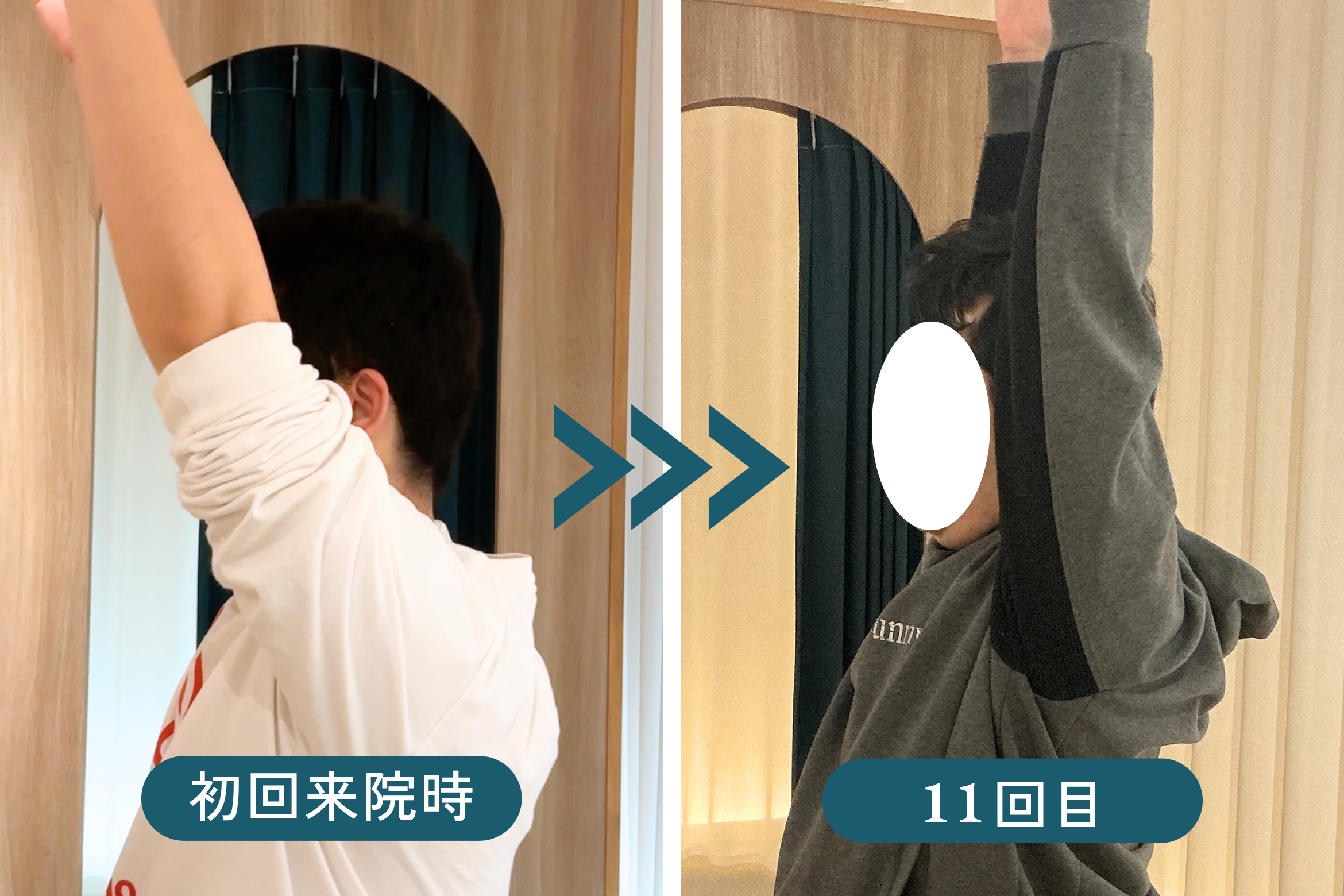 T様 施術前と施術後の比較。首肩の可動域と姿勢のラインが整っている様子